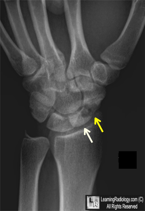 LearningRadiology Avascular Necrosis Scaphoid, AVN, navicular